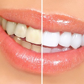 Before and after teeth whitening
