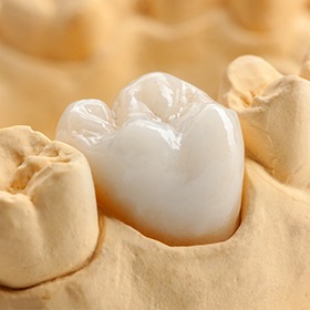 Smile model with dental crown restoration