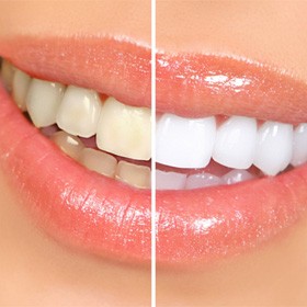 Opalescence Boost teeth whitening kit