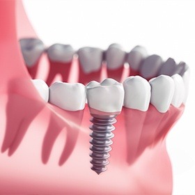 dental implant in Goode in the bottom jaw