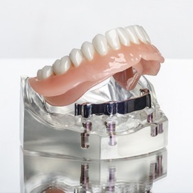 Model implant supported denture