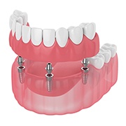 Digital illustration of implant dentures in Goode