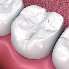 Animation of tooth with composite filling