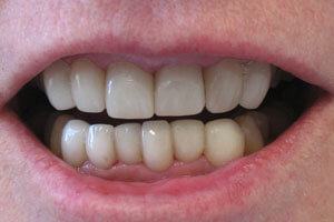 Healthy white smile after treatment