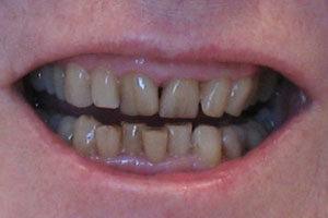 Damaged and discolored smile