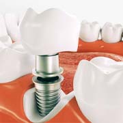 Model showing each part of a dental implant
