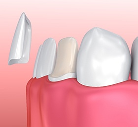 Illustration of porcelain veneer being placed on prepared tooth