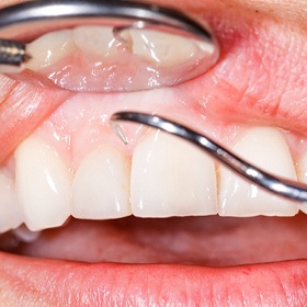 Man at dentist for dental cleaning.