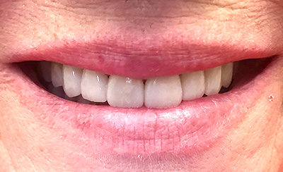 Healthy white smile after treatment