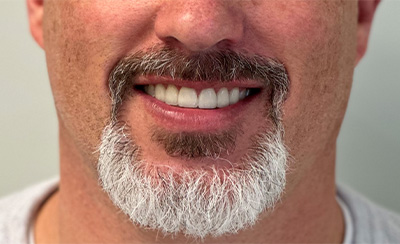 Brilliant white smile after treatment