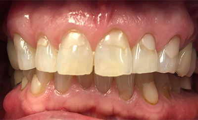 Decayed and missing teeth before treatment
