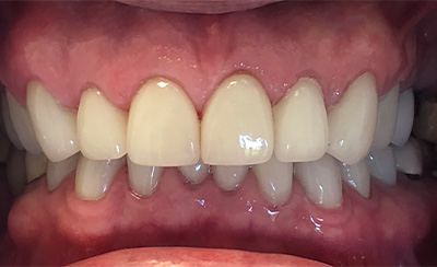 Healthy smile and replaced tooth structure