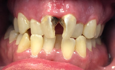 Several missing and broken top teeth