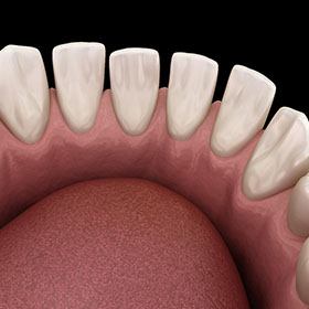 a digital illustration of gaps between teeth