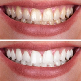 before and after teeth whitening