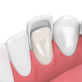 Animation of porcelain veneer placement