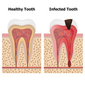 Good oral hygiene is vital for many reasons, including looking good. If you don’t take care of your teeth, you could end up needing root canal therapy in Goode.