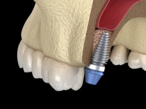 Upper dental implant and abutment