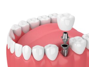 Illustration of a bottom arch of teeth and one of them is a dental implant with the crown levitating over the support rod