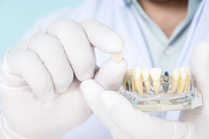 Dentist carefully holding a dental implant crown and model